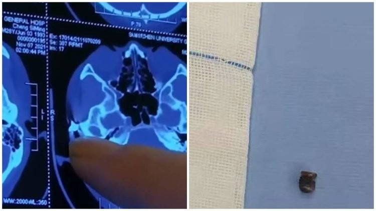 टाउको दुखेर अस्पताल जाँदा खप्परभित्र २० वर्षअघिको गोली !