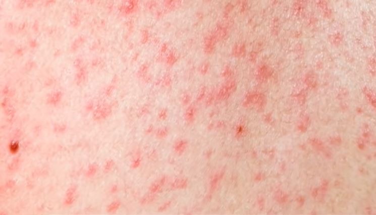 बाँकेमा दादुरा फैलिएपछि खोप कार्यक्रम चलाउने सरकारको तयारी