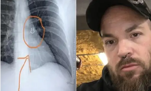 छाती धेरै दुखेर जचाउन जादाँ एक्सरेमा देखियो पाँच वर्षअघि हराएको नत्थी